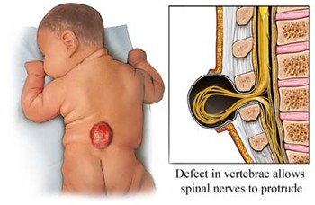 spinal nerves protrude