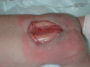 Baby With Spinal Growth