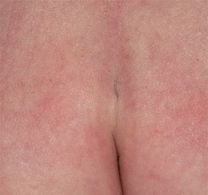 Sacral Dimple
