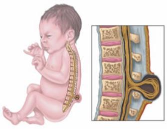 Spina Bifida Image