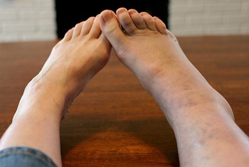 Swollen Ankles