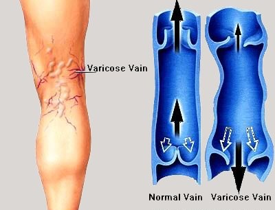 Varicose Veins