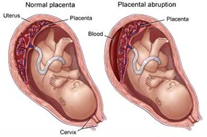 picture of placenta seperating