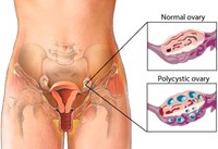 PCOS Picture