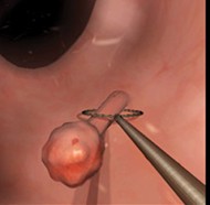 Polypectomy Surgery