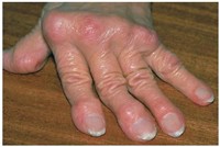 symptoms of rheumatoid arthritis in the hand