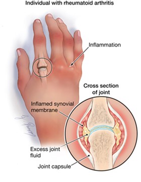 picture of rheumatoid arthritis