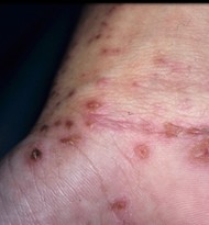 scabies on the wrist