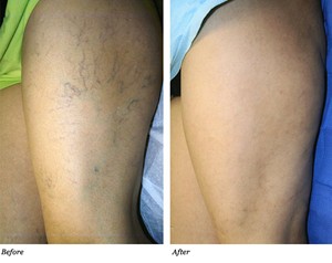 pictures of spider veins before and after