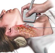 Stroke Prevention