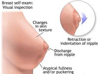 Signs of Breast Cancer in Women