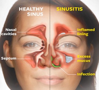 sinusitis signs