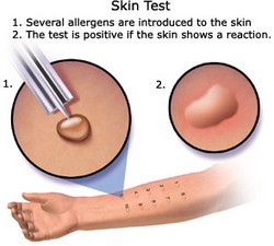 Skin Prick Test