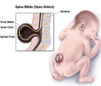 spina bifida picture