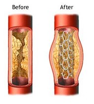 Picture of Stent