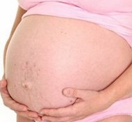 stretch marks during pregnancy