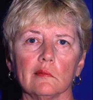 Left side of the face affected after stroke