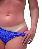 sunburn signs