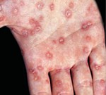 syphillis hand rash