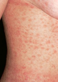 Stage two syphilis rash