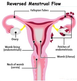 diagram of reversed menstruation