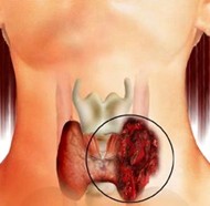 picture of thyroid cancer