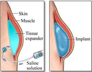 Tissue Expanders