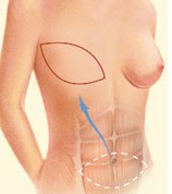 Tram Flap Surgery