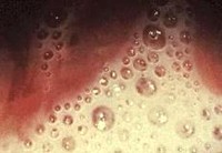picture of Trichomoniasis discharge in women