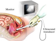 transvaginal ultrasound picture
