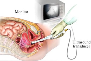 vaginal sonogram