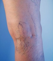 Spider Veins On Legs