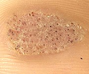 black spots in plantar wart