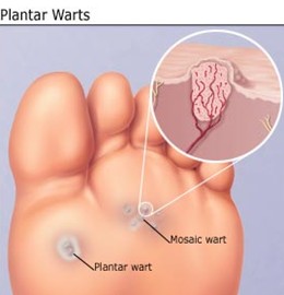 plantar wart picture