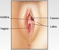 Vulvar Disorders