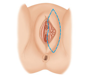 Picture of Vulva Cancer