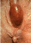 childbirth hematoma