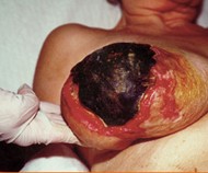 Warfarin Necrosis