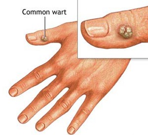 warts treatments