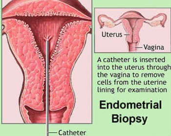 biopsy of womb